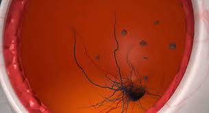 Moscas Volantes Clinica Oftalmologica Madrid Dr Cintrano