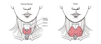 Image result for Multinodular Goiter