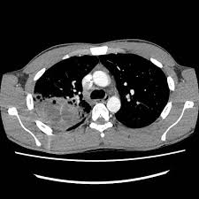 Image result for Lung Abscess