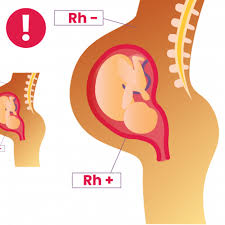 Image result for Rh Sensitization
