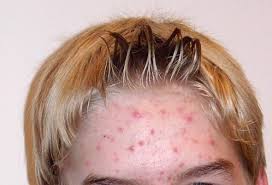 Akne Warum Vitamin B12 Die Pickel Verschlimmert Vitamin Verandert Die Genaktivitat Der Hautbakterien Und Fordert So Die Entzundung Scinexx De