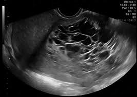 Sonographic Diagnosis Of Uterine Ewing Sarcoma Ultrasound Leiomyosarcoma Sarcoma