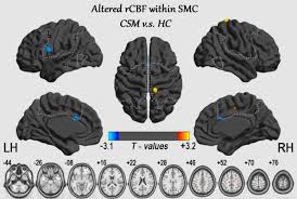It is not intended for promotion any illegal things. Altered Perfusion Of The Sensorimotor Cortex In Patients With Cervical Jpr