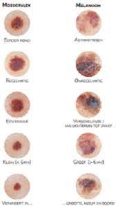 El cáncer de piel no melanoma puede tener el aspecto de diversas marcas en la piel. El Cancer De Piel