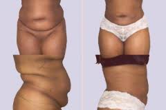 Zekerheid Bij Liposuctie En Liposculptuur Parkkliniek Rotterdam