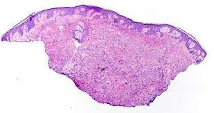 Image result for Leiomyosarcoma