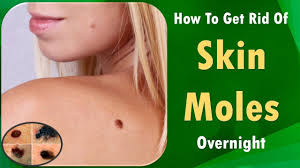Some people have a higher than average risk of their moles becoming cancerous and developing into melanoma. How To Get Rid Of Moles How To How To Get Rid Of Moles