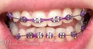 Black And White Braces Color 4 Months On Braces Braces Review Part 6 Miss Carin Braces Colors Braces Teeth Colors Braces