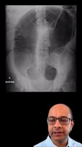 Image result for Sigmoid Volvulus