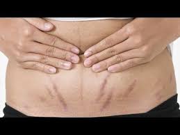 Bio Oil Stretch Marks Before And After Pin On Stretch Marks Before And After