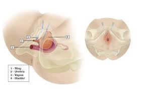 Mid Urethral Sling Austin Urogynecology