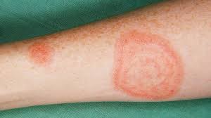 8 Common Types Of Rashes Everyday Health