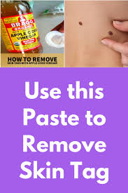 Use This Paste To Remove Skin Tag This Home Remedy Will Remove Skin Tag Easily At Home The Skin Tag Removal Skin Tags Home Remedies Remove Skin Tags Naturally