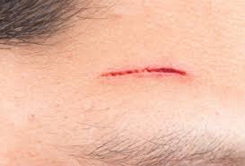 Use sterile gauze and a bandage to cover the wound. Facial Wounds Healing Times For Cuts And Scars Advanced Tissue