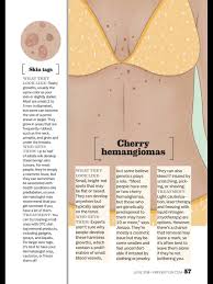 They may bleed when subjected to trauma (such as by squeezing them) it is actually caused by a collection of blood vessels. Skintags Angiomas See The Difference With Dr Schreiber And Expert Team We Are Able To Remove Inflammed And Blee Dermatology Skin Tag Cherry Angioma Removal