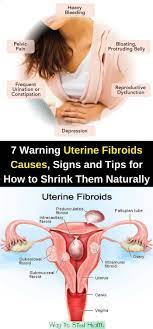 Uterine Fibroids Are Defined As Benign Tumors Which Develop In The Uterus Even Though They Are Made Of The Same Muscl Uterine Fibroids Fibroids Fibroid Uterus