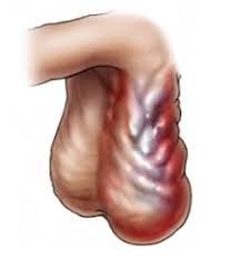 Image result for Varicocele