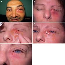 Image result for Dacryoadenitis