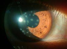 Noninfectious keratitis can be caused by a relatively minor injury, by wearing your contact lenses basics of hsv (herpes simplex virus) keratitis. Keratitis Wikipedia