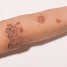 Image result for Impetigo