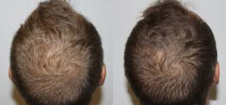 The most common causes of scalp damage are due to daily acts of care. Keravive The Hydrafacial For Your Scalp Vancouver