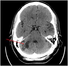 Image result for Neurosyphilis