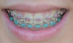 Black And Baby Blue Braces Pin Ot Polzovatelya Yelizaveta Romanova Na Doske Brekety Brekety Estetika