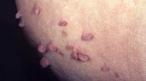 Image result for sore skin in the groin area