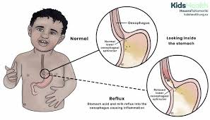 Image result for Pediatric Reflux
