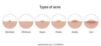 Image result for Pustule