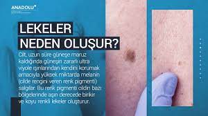 vucuttaki kahverengi lekeler nasil gecirilir youtube