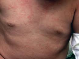 They chiefly cause upper respiratory tract infections (urtis) but may also infect the lower respiratory tract. Viral Rash Types Symptoms And Treatment In Adults And Babies