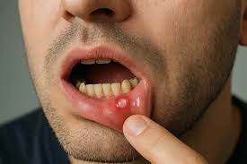 Image result for mouth ulcer on tongue)