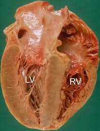 Image result for Restrictive Cardiomyopathy