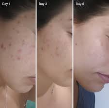 It inhibits the production of melanin and fades away now that you know why vitamin c is great for your skin, don't wait too long before you get a. Vitamin C For Acne Scars Efficacy How It Works Before And Afters