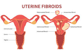 However, they are clinically apparent in up to 25% of all women and cause significant morbidity (disease), including prolonged or heavy menstrual bleeding, pelvic pressure or pain, and, in rare cases. Uterine Fibroids Causes Symptoms Treatment Gleneagles Hospital