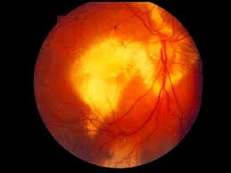 Routine Eye Exam Rare Diagnosis Air Force Medical Service Display