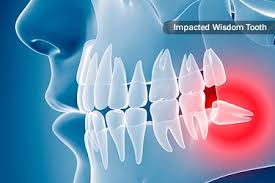 Gum detoxify deep clean, detoxify gentle whitening Wisdom Teeth What They Look Like Other Things To Know