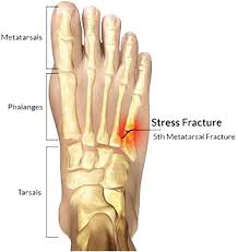 Image result for Fracture