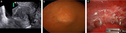 They resemble small, flat patches or flecks on the pelvic surface. Performance Of Ultrasound Based Endometriosis Staging System Ubess For Predicting Level Of Complexity Of Laparoscopic Surgery For Endometriosis Menakaya 2016 Ultrasound In Obstetrics Amp Gynecology Wiley Online Library