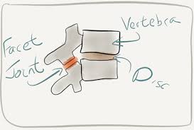 Then proceed to unlock it. Facet Joint Syndrome Sundial Clinics