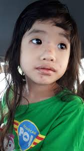 The virus then multiplies at the site of intrusion, mainly in the. Rawatan Chickenpox Aura Ummi