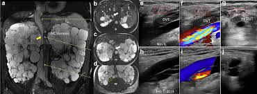 View the profiles of people named irina barash. Prevalence Of Inferior Vena Cava Compression In Adpkd Kidney International Reports