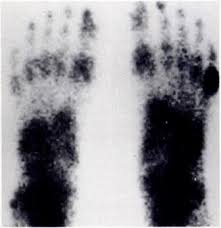 Image result for Osteomyelitis Bone Scan