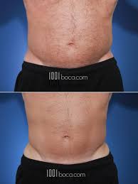 If there's excess skin and fat that bulges above or below your ring, it's a sign that it's too small and it's causing when your leggings are too tight, they're likely to create a leg muffin. Coolsculpting Before And After Photos
