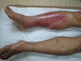 La trombosis venosa superficial puede causar molestias, pero no suelen causar la trombosis venosa superficial; Erisipela O Flebitis Arterias Y Venas