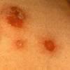 Auch die dekolonisation von mrsa auf wunden ist damit möglich. 1