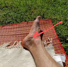Bone pain, often at night. Anybody Also Have A Lump Here Feels Like A Muscle I Struggle With Overpronation But I Dont Know If That S The Cause What Is Wrong With Your Feet Is A Common Remark