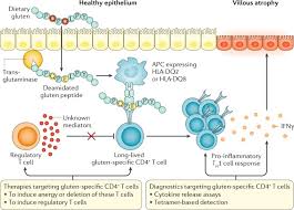 Coeliac disease is a condition where the lining of the small bowel is damaged due to a protein in food called gluten. T Cells In Coeliac Disease A Rational Target For Diagnosis And Therapy Nature Reviews Gastroenterology Hepatology