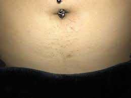 Woman removes belly button, sends it to her boyfriend as a 'gift'. What Should I Do About Thick Hair And Ingrown Hair I Get In The Area Under My Belly Button Photo